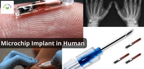 Augmented body surveillance: Human microchip implantations 